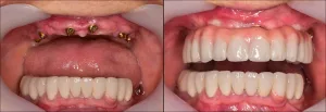full mouth reconstructing by implants and crowns