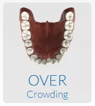 Over Crowding Teeth
