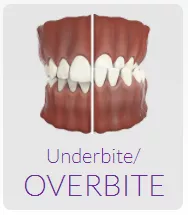 Underbite/Overbite Teeth